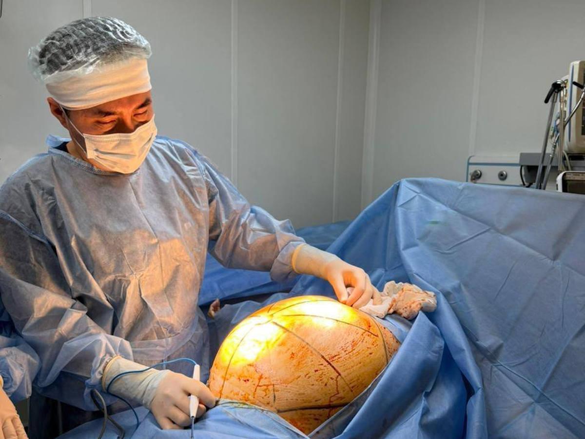 В Алматы женщине удалили опухоль весом 25 килограммов